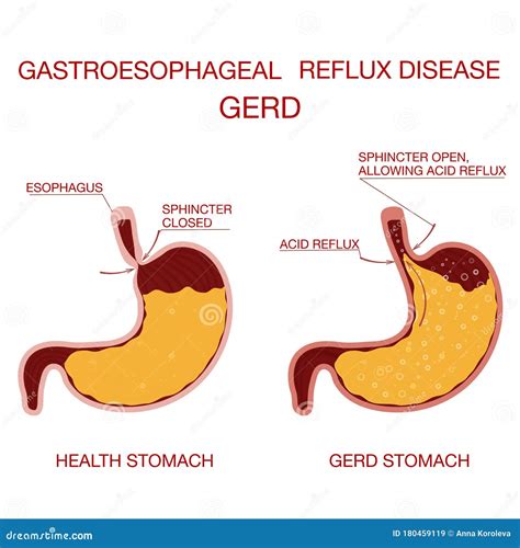 Acid Reflux (Gerd): Simptomai Ir Gydymas