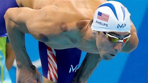 Michael Phelps 'Rare Kneuzingen: Werkt Cupping Therapie Echt?
