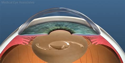 New Eye Implant Wist Bewolkte Visie