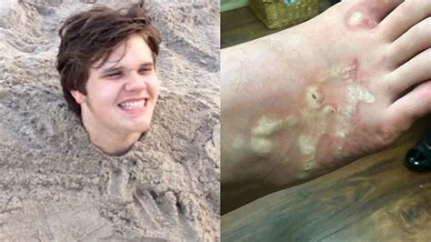 Tinejdžer Dobiva Hookworm Iz Florida Beach Sand
